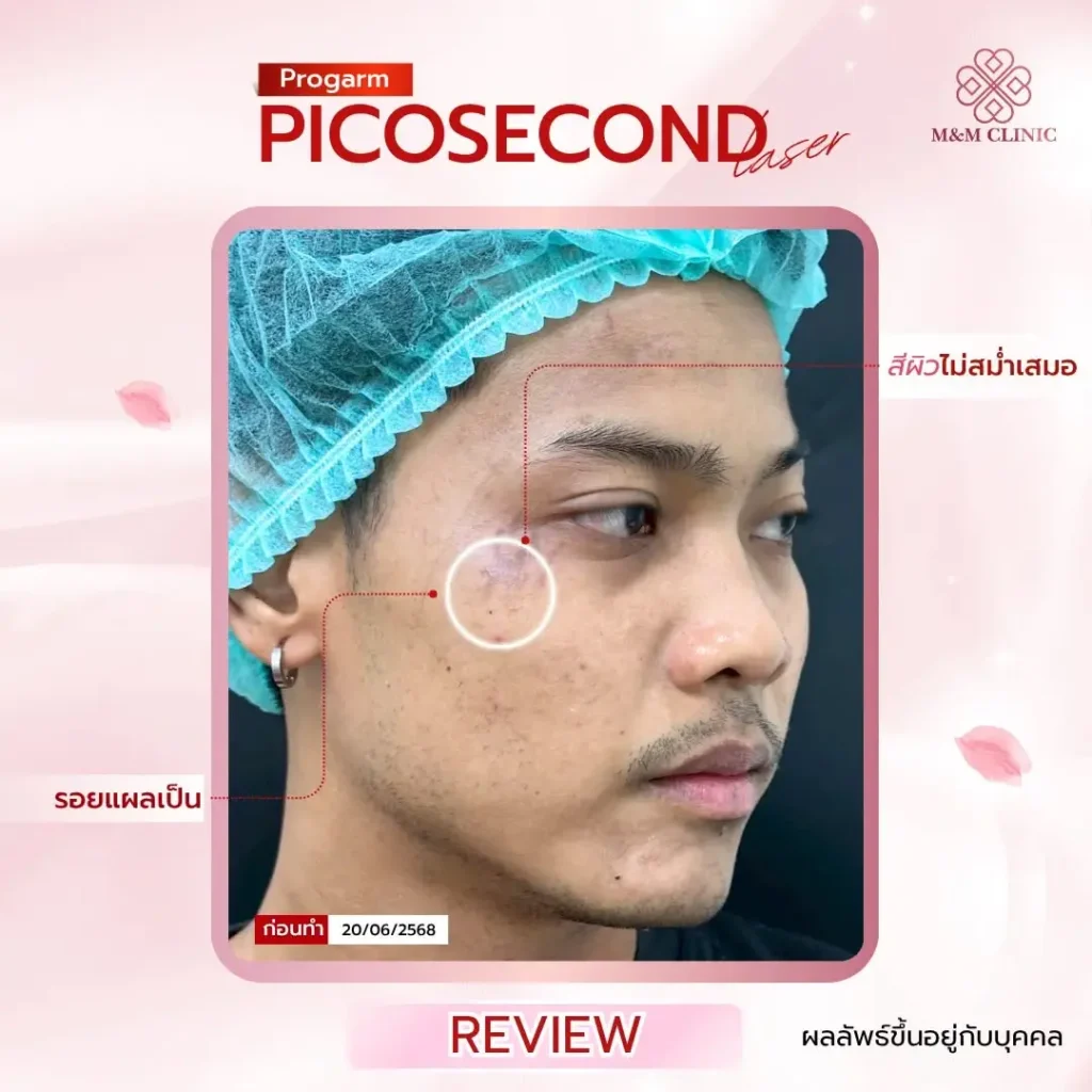 Pico Laser