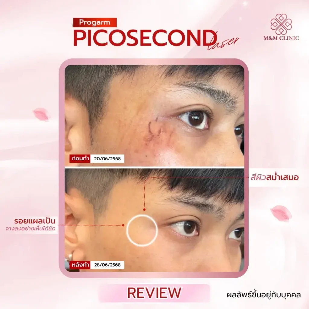 Pico Laser